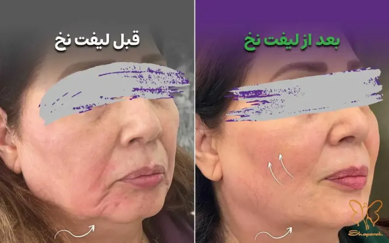 لیفت صورت با نخ کلینیک شاپرک مشهد